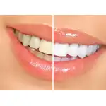 Gel pencil set for teeth whitening, SHINE, 3 x 2 ml